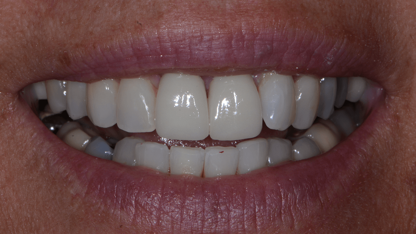 teeth after crown lengthening