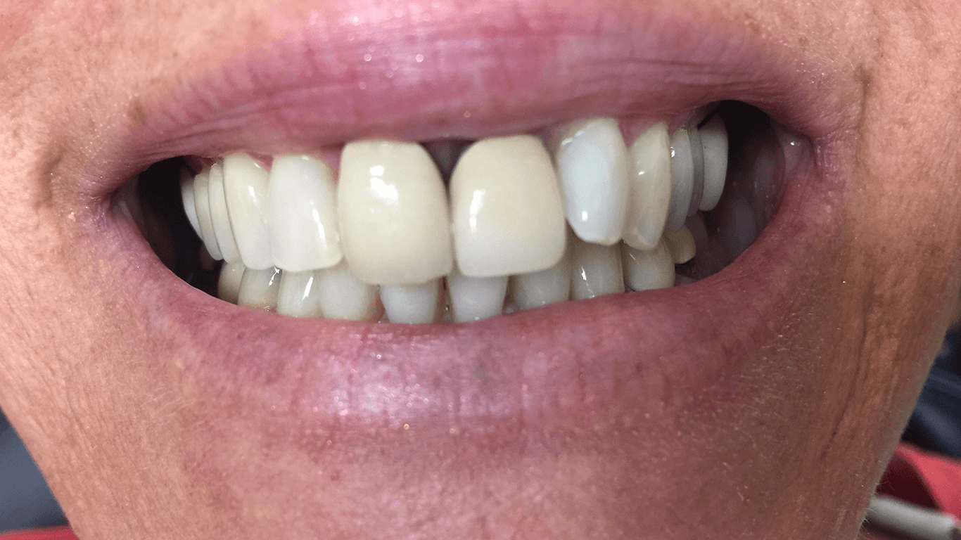 teeth before crown lengthening