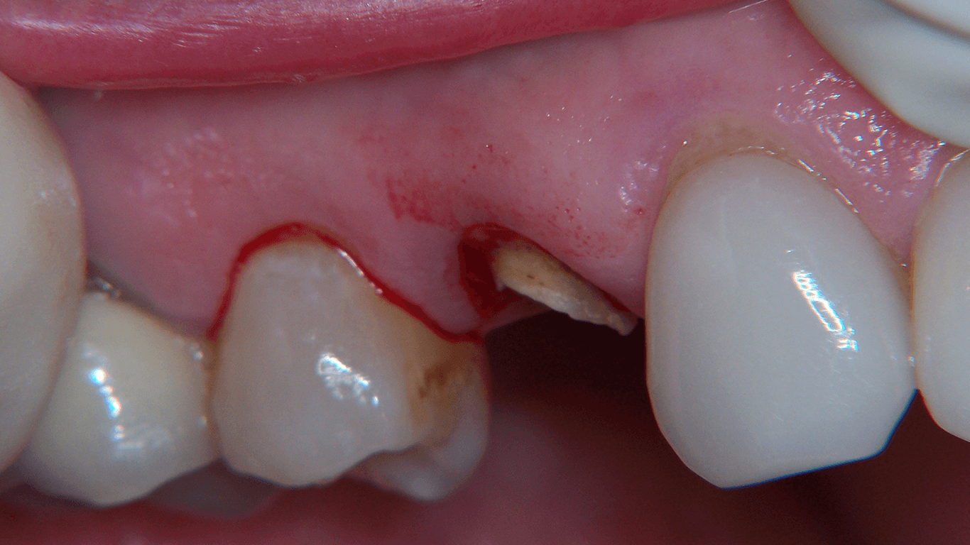 closeup of a missing tooth before a dental implant procedure