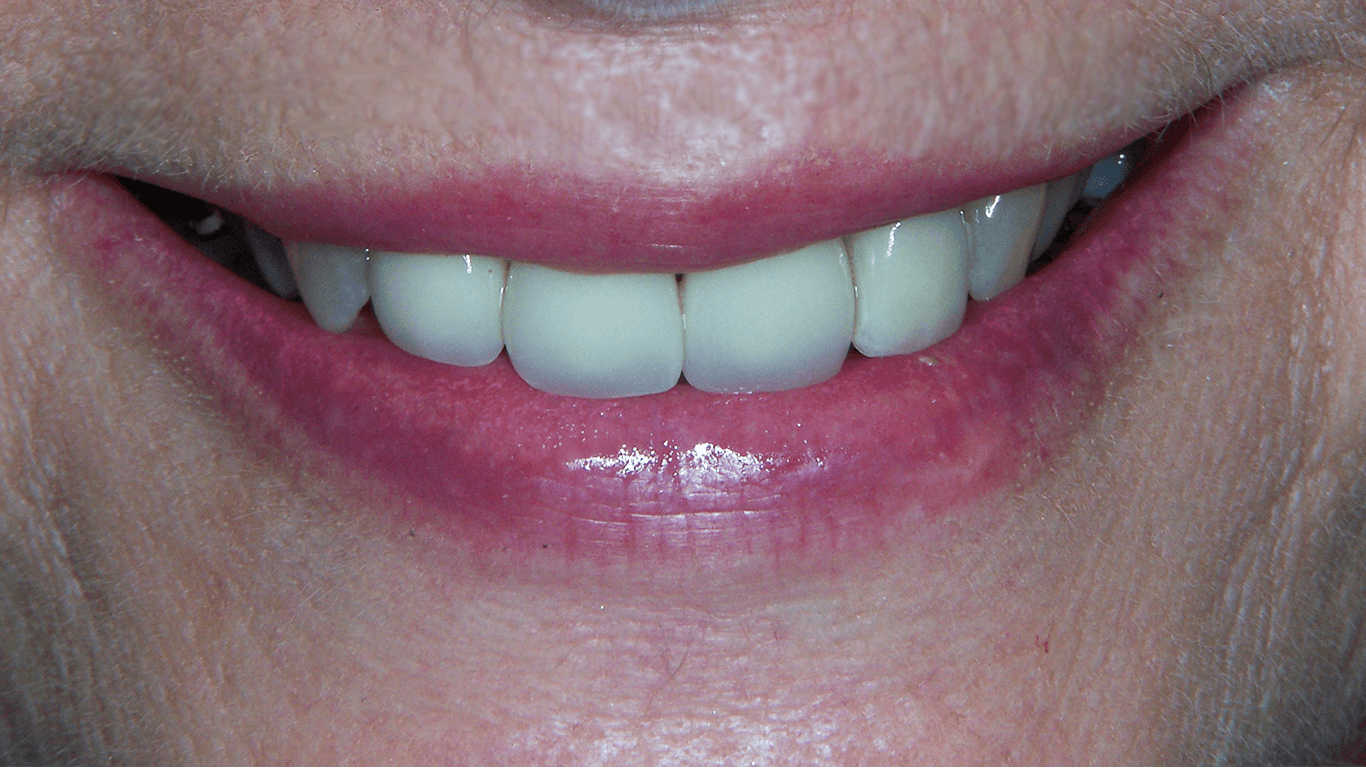 teeth after dental implants