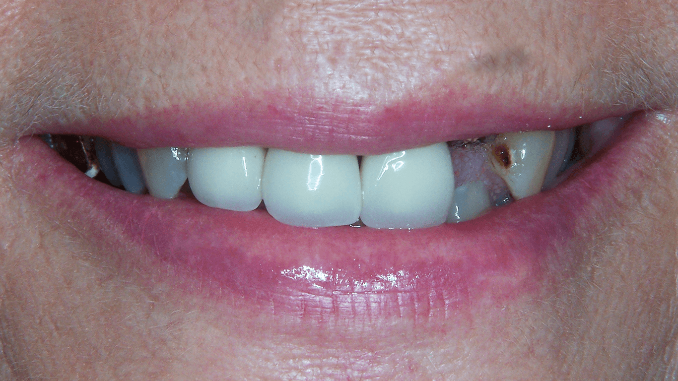 broken teeth before dental implants