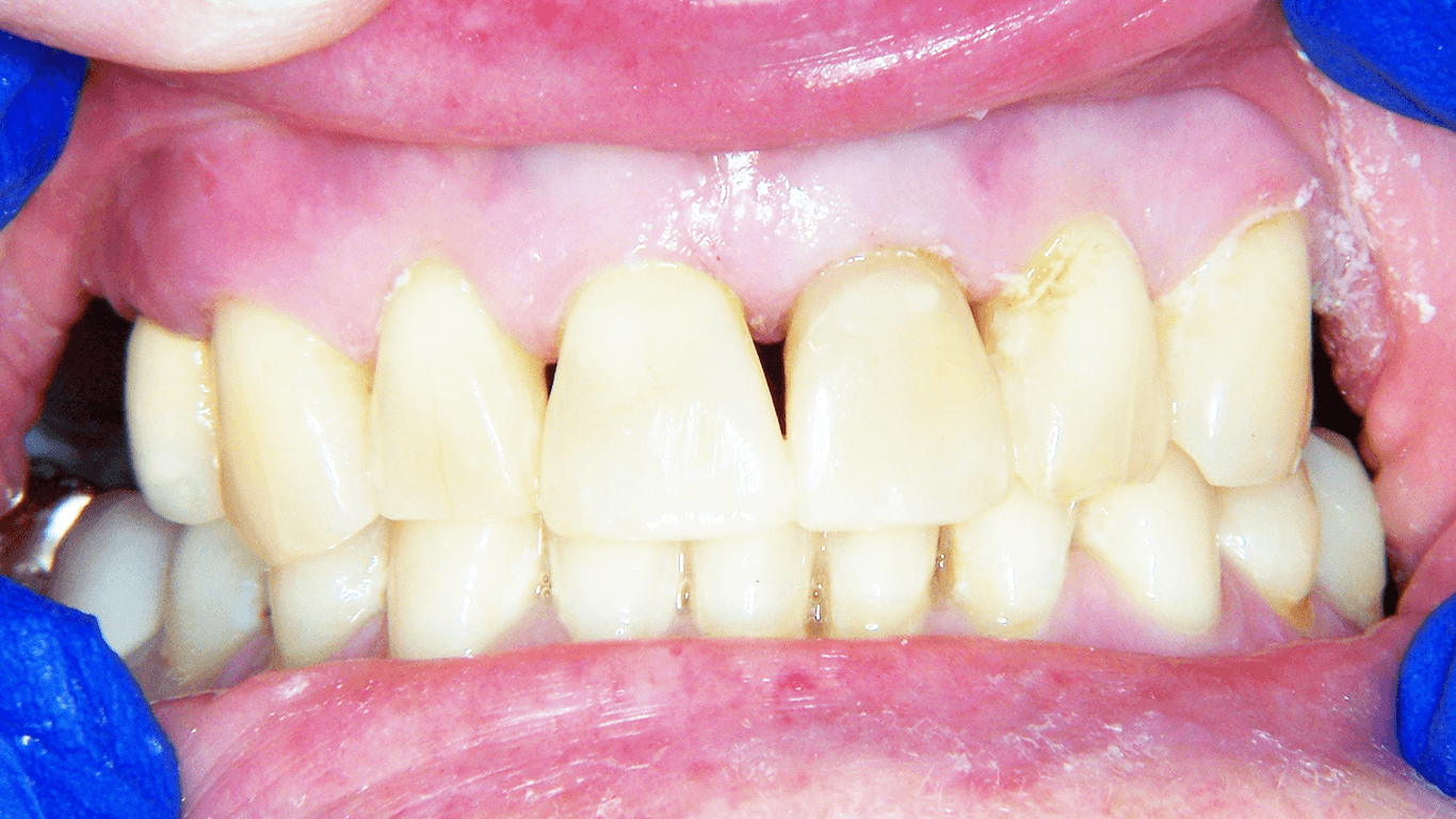 teeth after dental bonding