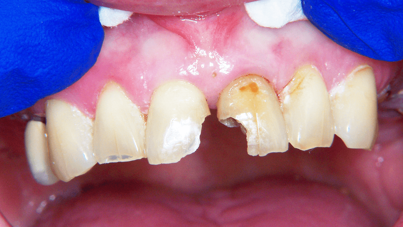 broken teeth before a dental bonding procedure