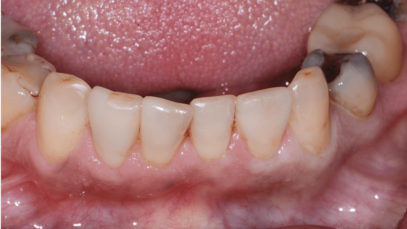 teeth after fillings were implanted