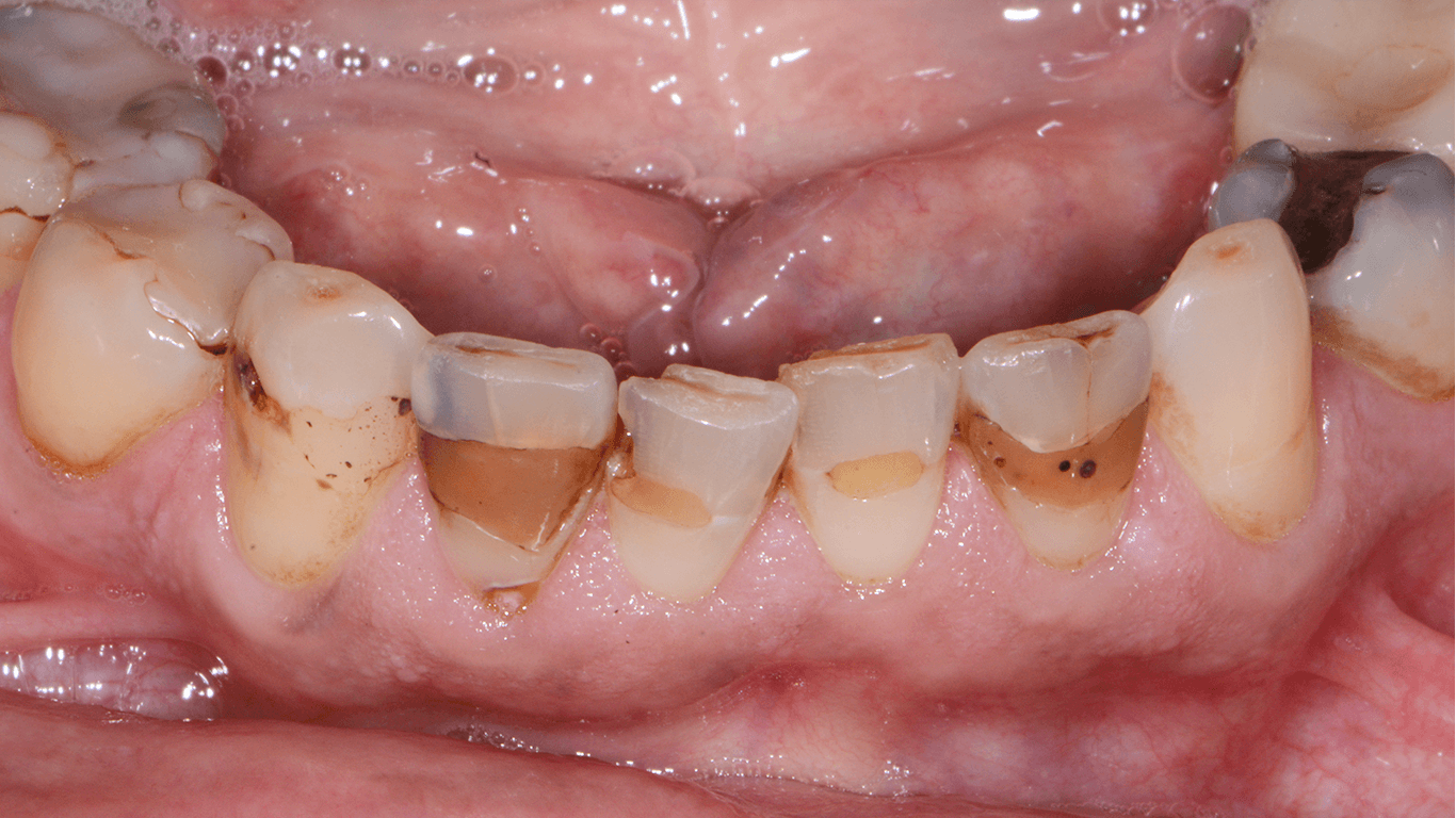 teeth before filling implants