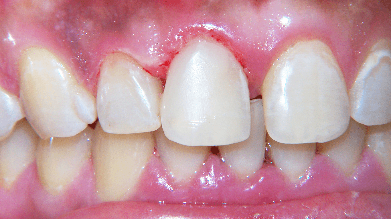 teeth after a tooth decay procedure