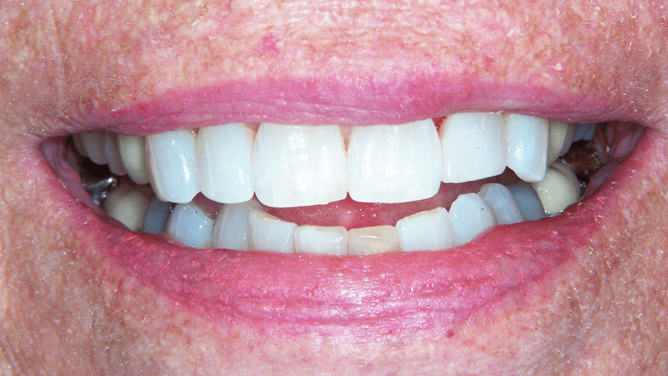 teeth after white fillings