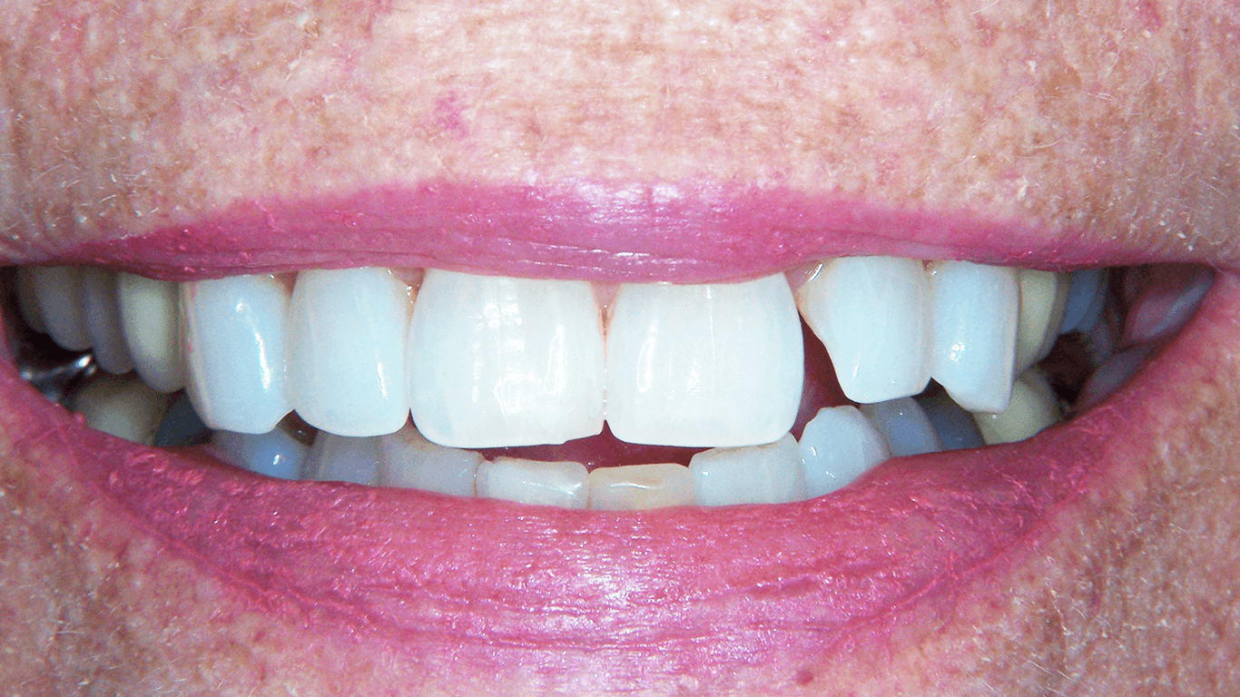 teeth after white fillings